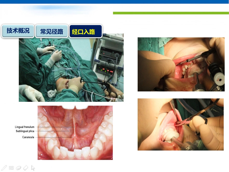经口入路腔镜甲状腺切除术课件_第5页
