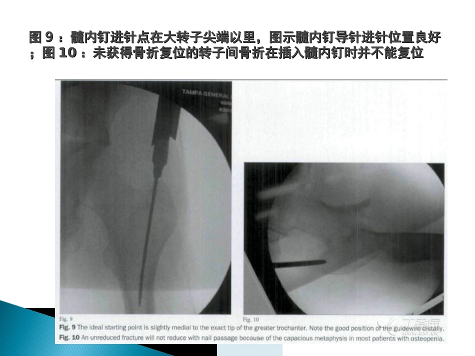 外科学：转子间骨折的10个手术技巧_第13页