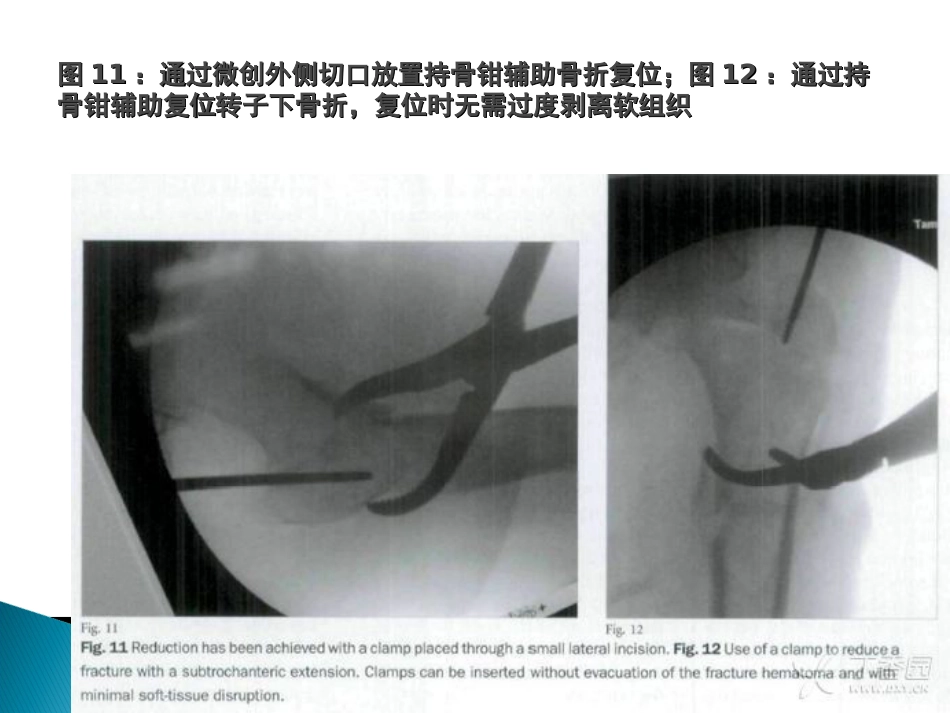 外科学：转子间骨折的10个手术技巧_第15页
