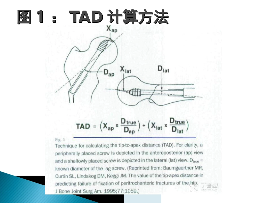 外科学：转子间骨折的10个手术技巧_第4页