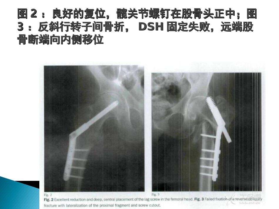 外科学：转子间骨折的10个手术技巧_第5页