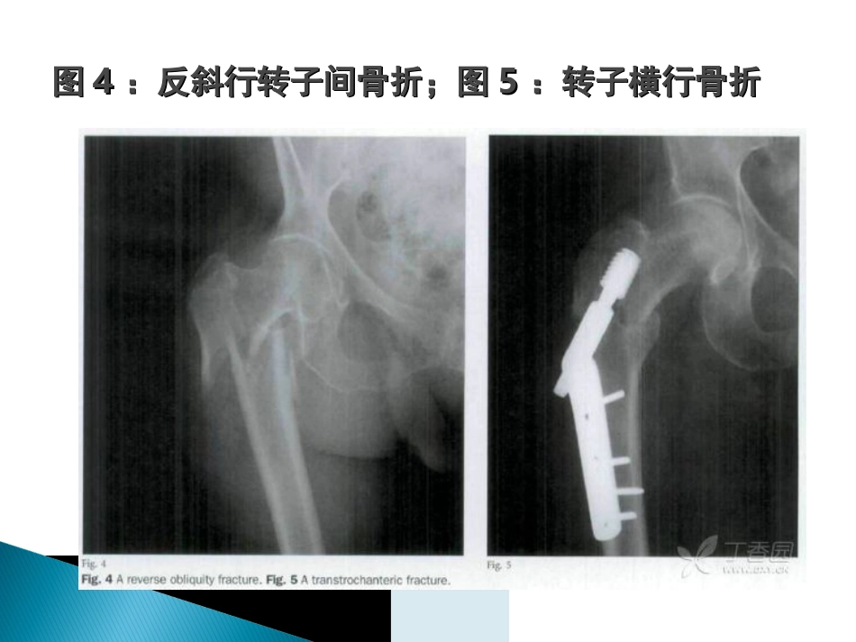 外科学：转子间骨折的10个手术技巧_第8页