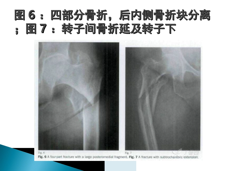外科学：转子间骨折的10个手术技巧_第9页