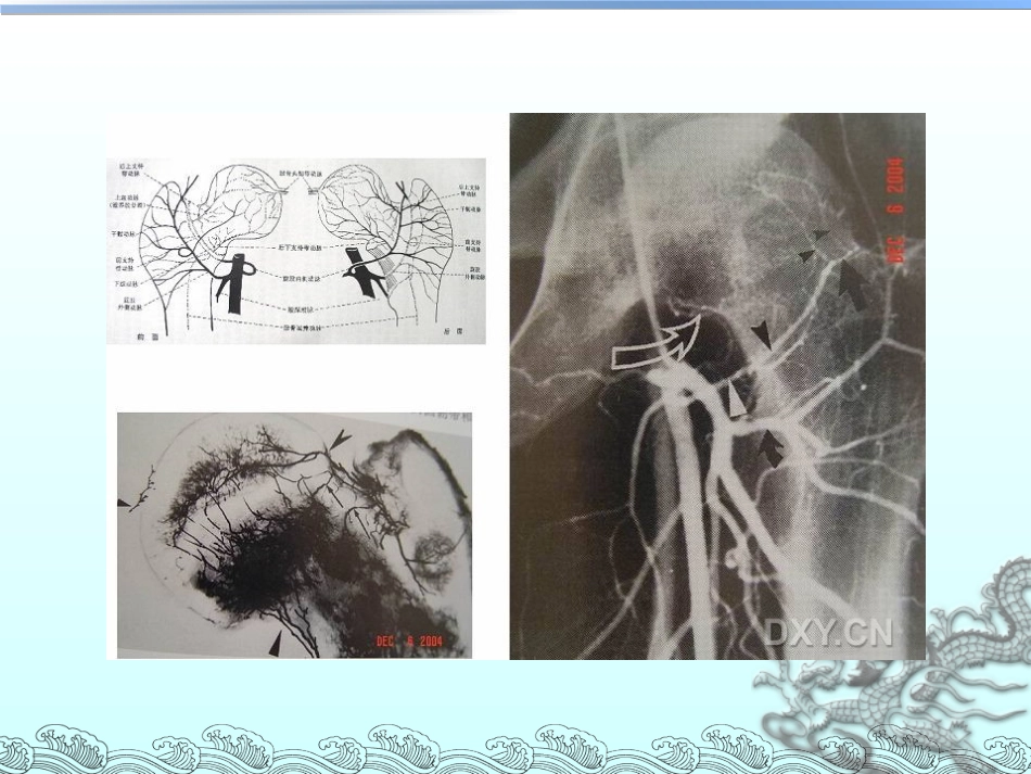 外科学：股骨头坏死的分型_第6页