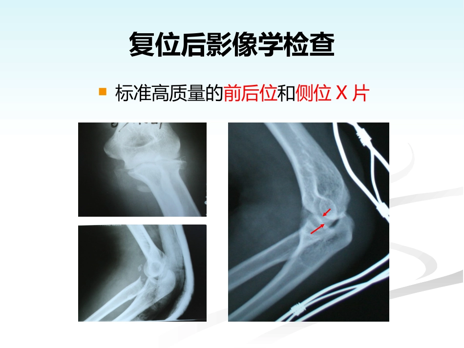 外科学：肘关节恐怖三联征的规范化外科治_第15页