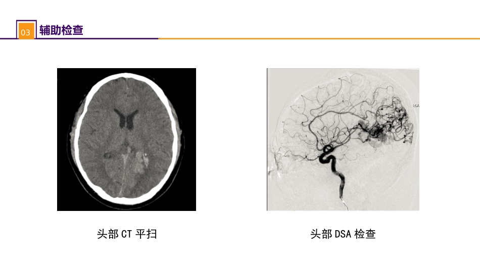 外科学：案例分析-颅内动静脉畸形破裂导致的蛛网膜下腔出血_第6页
