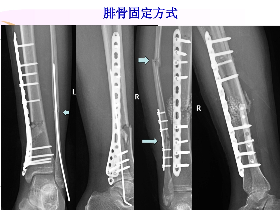 外科学：腓骨骨折 内固定._第10页