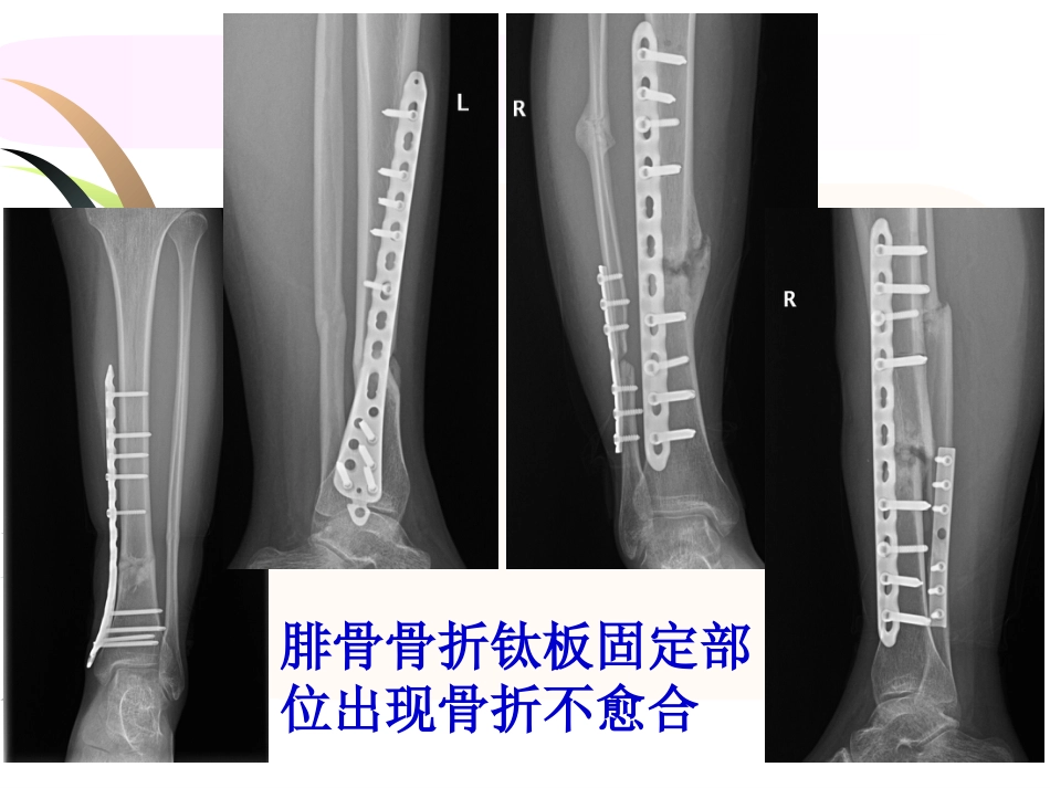 外科学：腓骨骨折 内固定._第12页