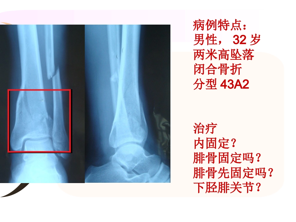 外科学：腓骨骨折 内固定._第2页