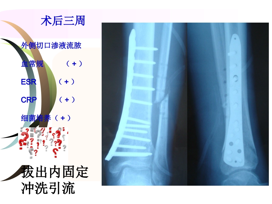 外科学：腓骨骨折 内固定._第4页