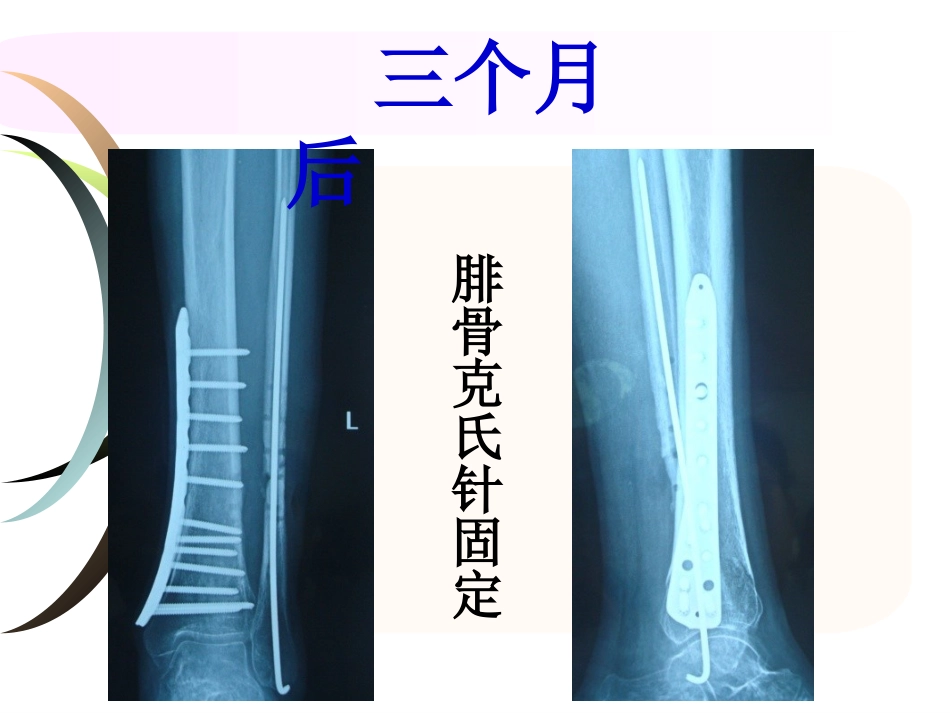 外科学：腓骨骨折 内固定._第5页