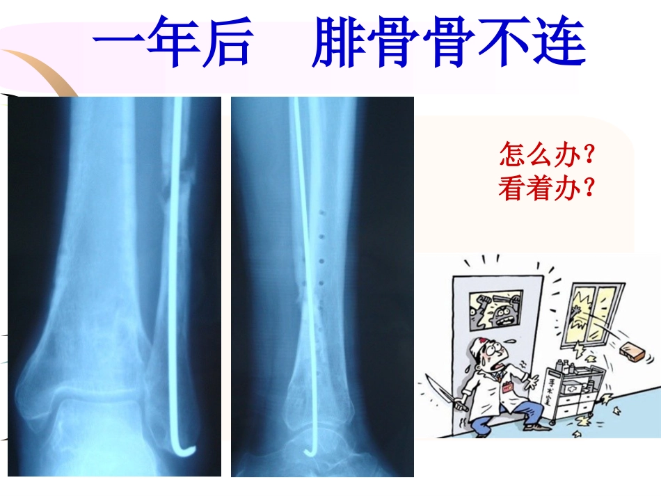 外科学：腓骨骨折 内固定._第6页