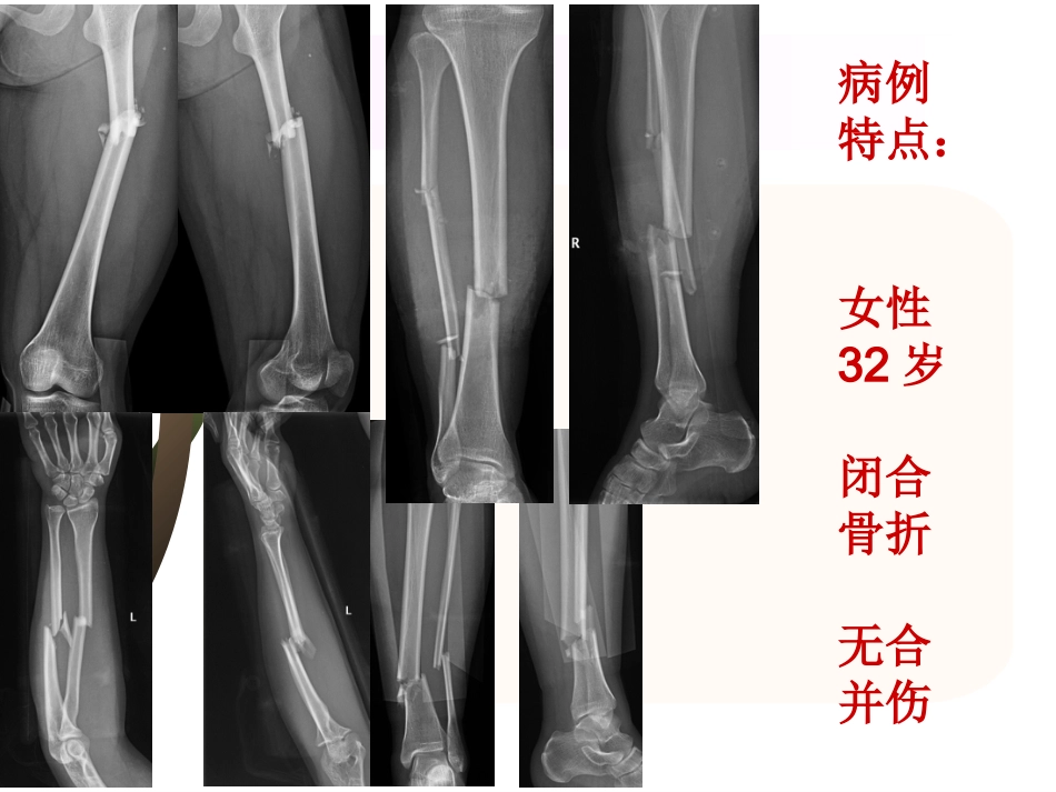 外科学：腓骨骨折 内固定._第8页