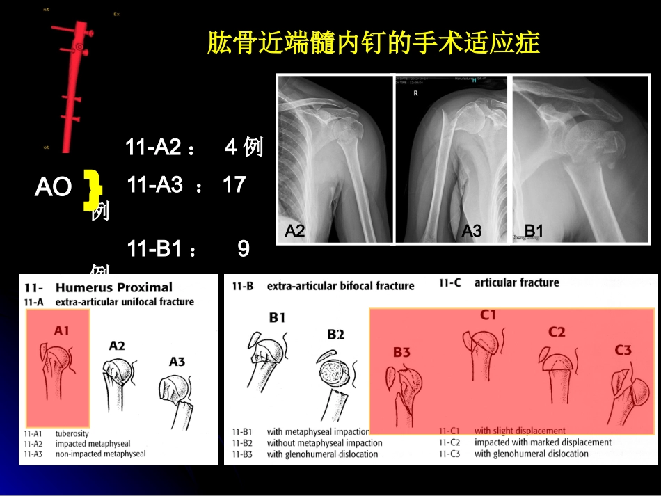 外科学：肱骨近端骨折髓内钉治疗_第13页