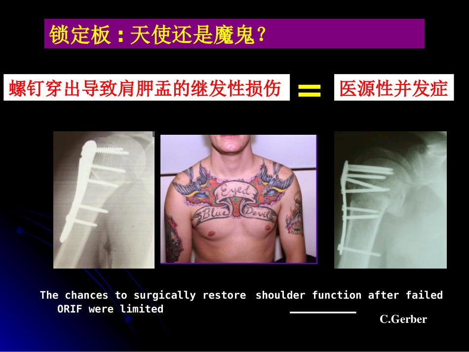 外科学：肱骨近端骨折髓内钉治疗_第5页