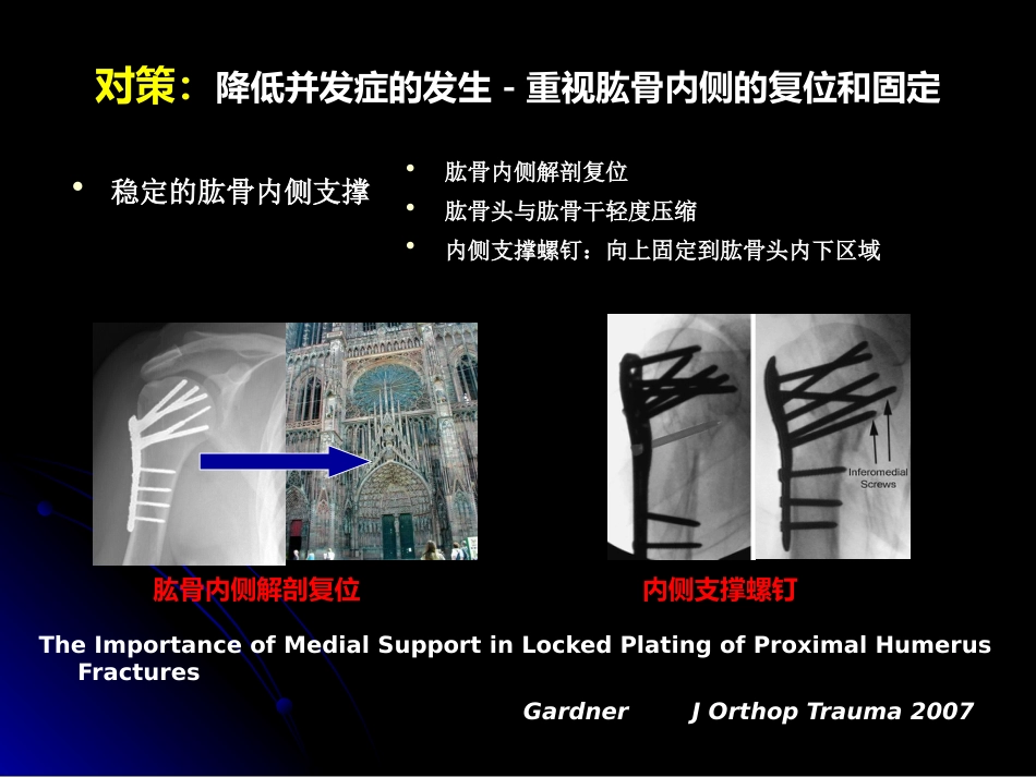 外科学：肱骨近端骨折髓内钉治疗_第6页
