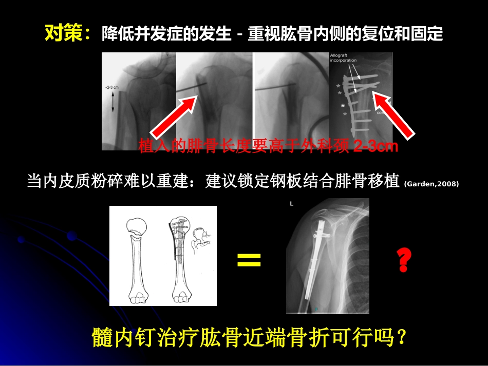外科学：肱骨近端骨折髓内钉治疗_第7页
