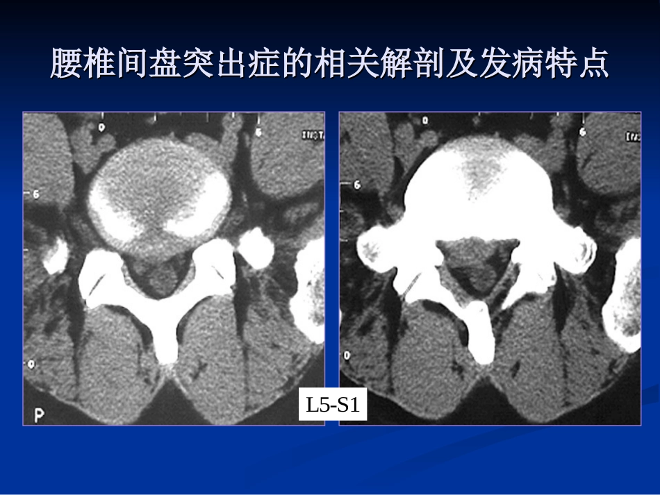 外科学：腰椎间盘突出症的诊断、鉴别诊断与分型_第12页