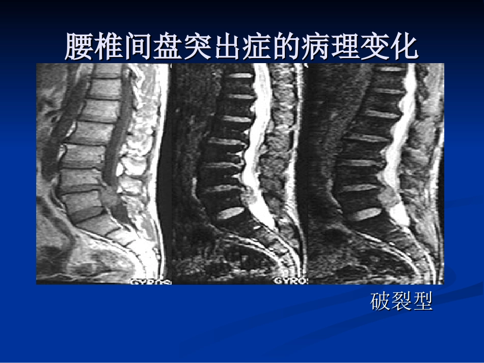 外科学：腰椎间盘突出症的诊断、鉴别诊断与分型_第15页