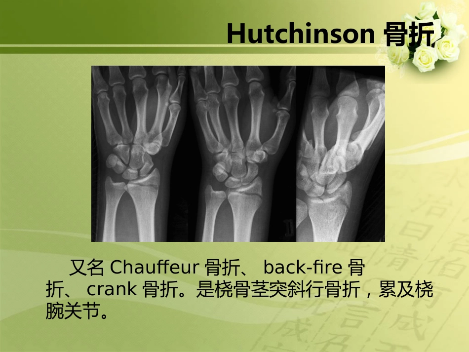 外科学：特殊类型骨折_第12页