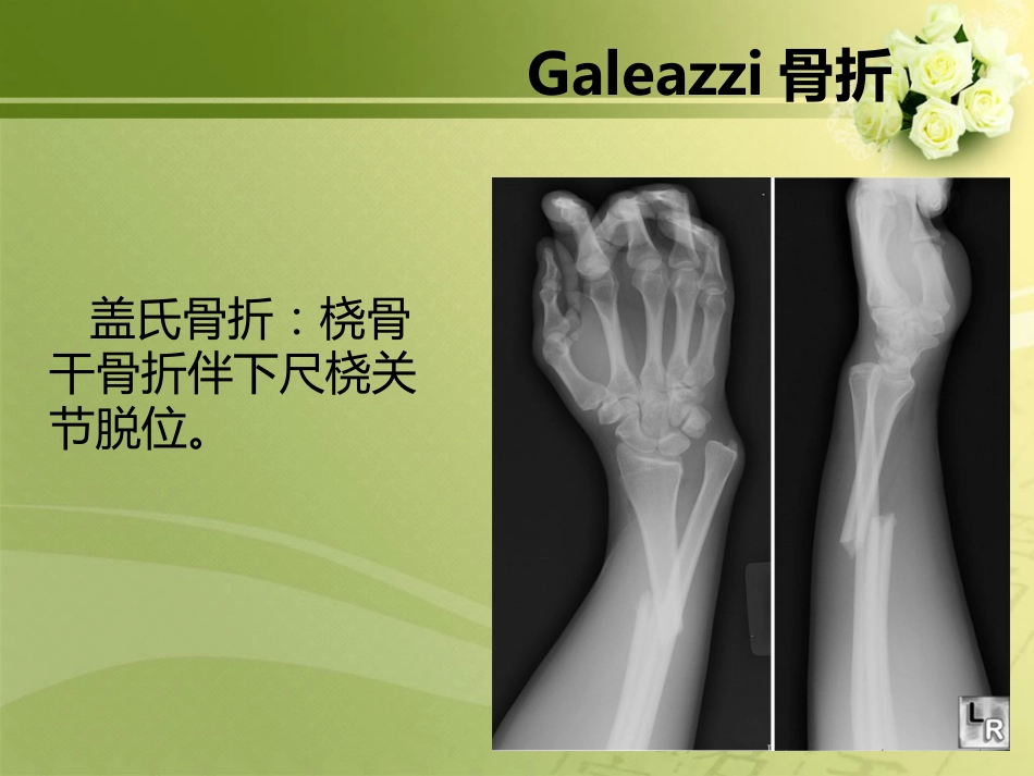 外科学：特殊类型骨折_第6页