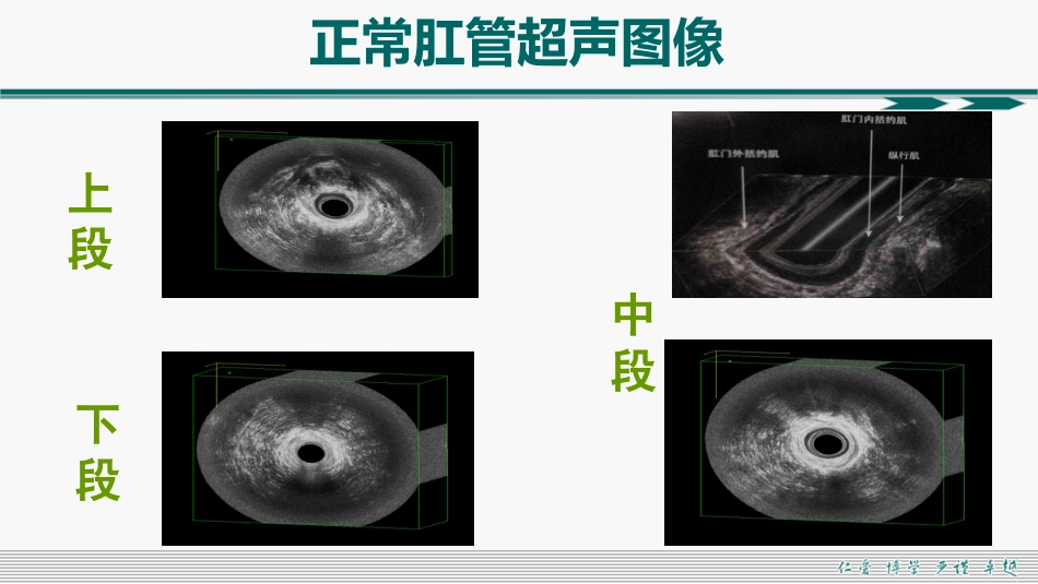 肛周脓肿和肛瘘超声诊断的临床思维_第9页