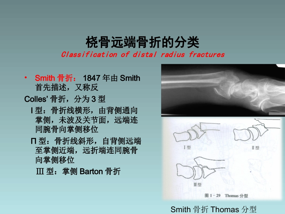 外科学：桡骨远端骨折的治疗_第13页