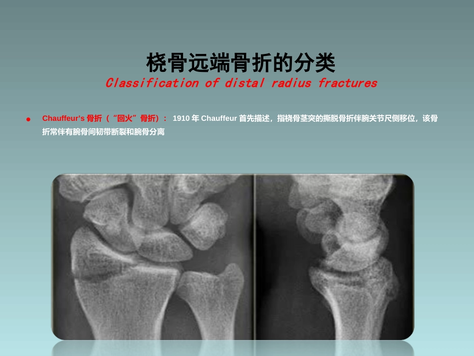 外科学：桡骨远端骨折的治疗_第15页