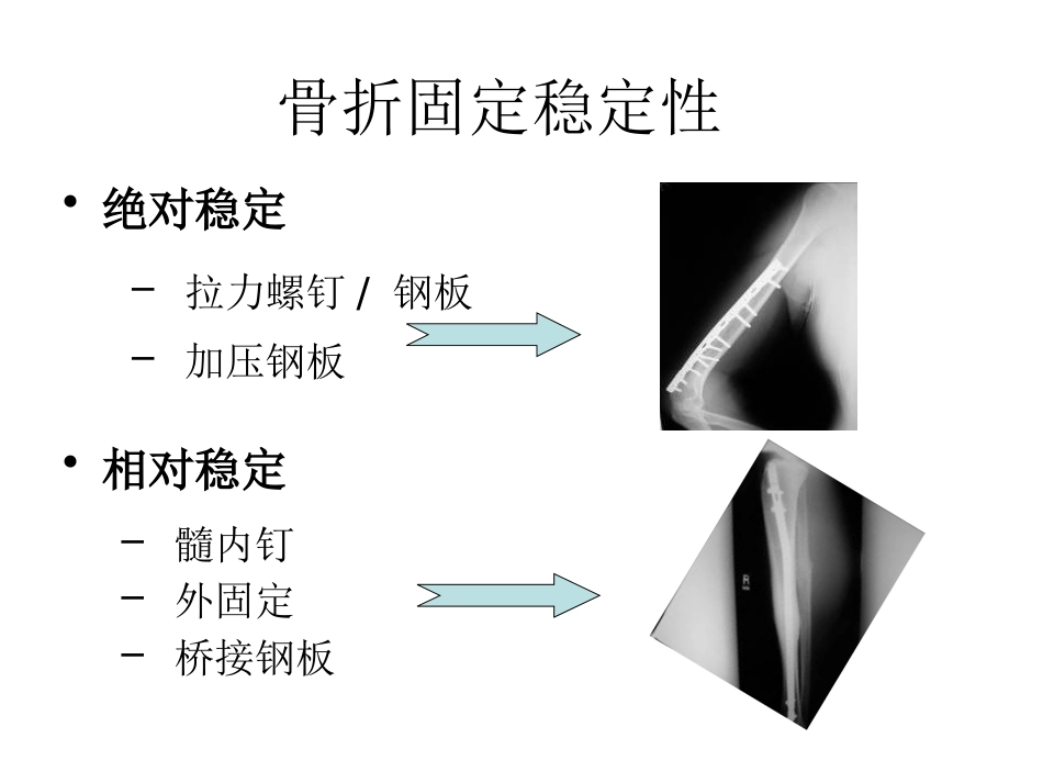 外科学：骨折内固定方案及选择原则_第4页