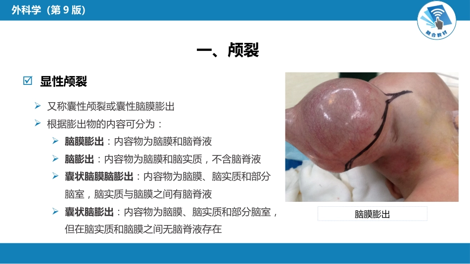 外科学：颅脑和脊髓先天畸形_第13页