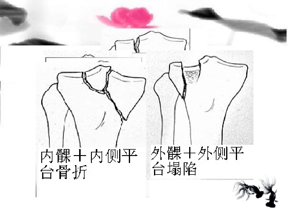 外科学：胫骨平台骨折治疗分型_第7页