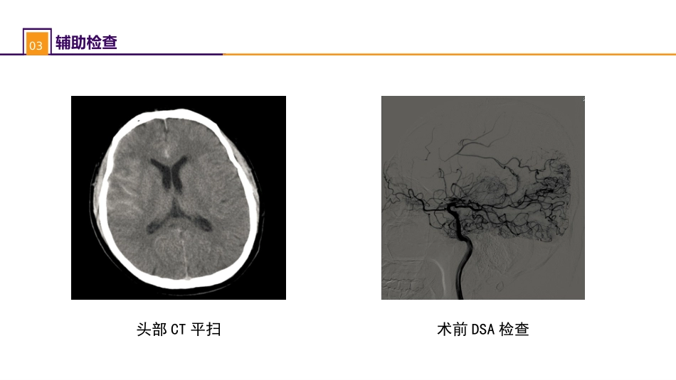 外科学：案例分析-烟雾病导致的蛛网膜下腔出血_第6页