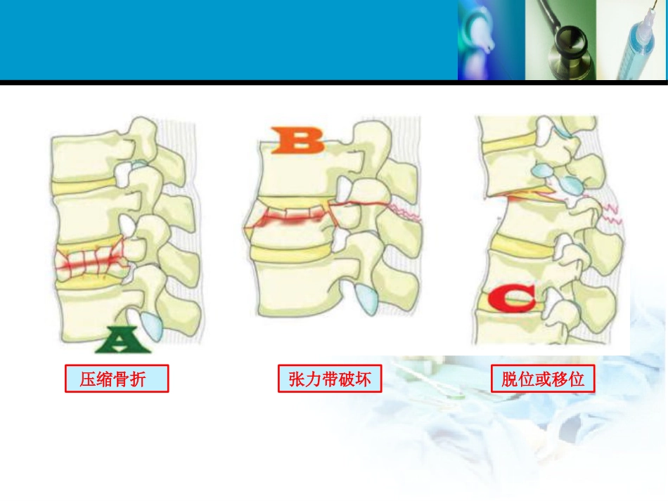 外科学：胸腰椎损伤分型_第10页