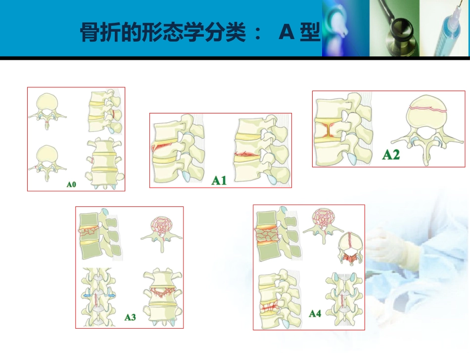 外科学：胸腰椎损伤分型_第11页