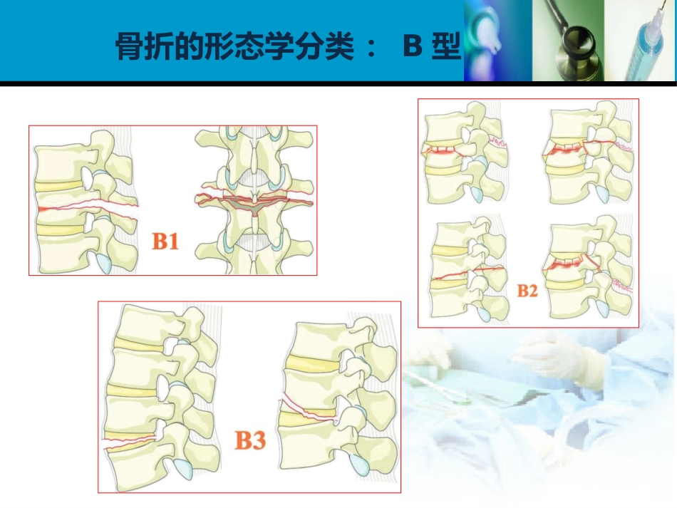 外科学：胸腰椎损伤分型_第12页