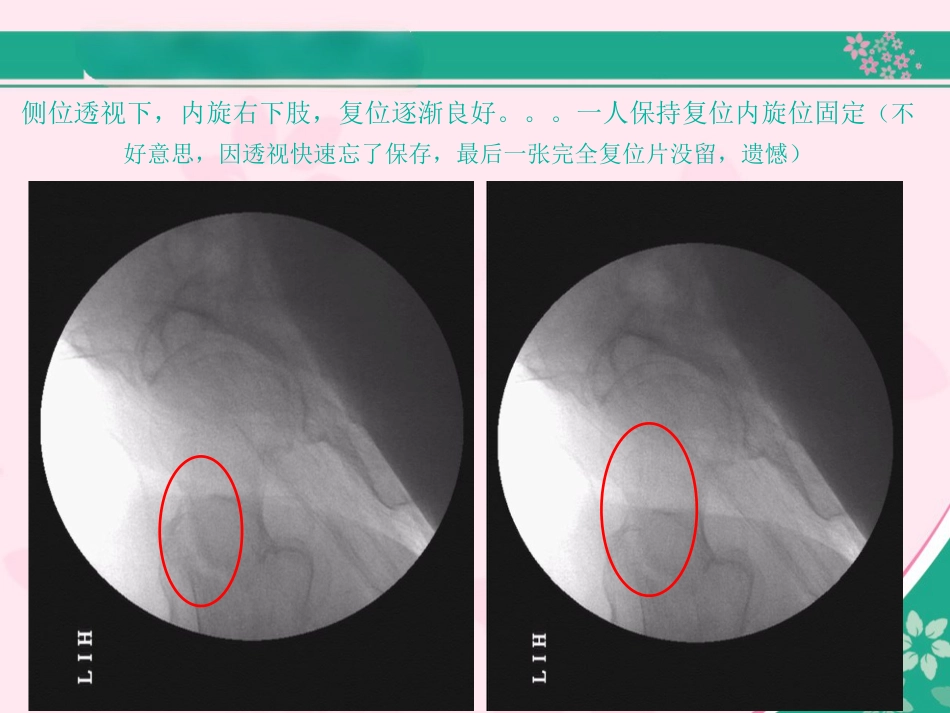 外科学：股骨近端骨折的几个感悟_第10页