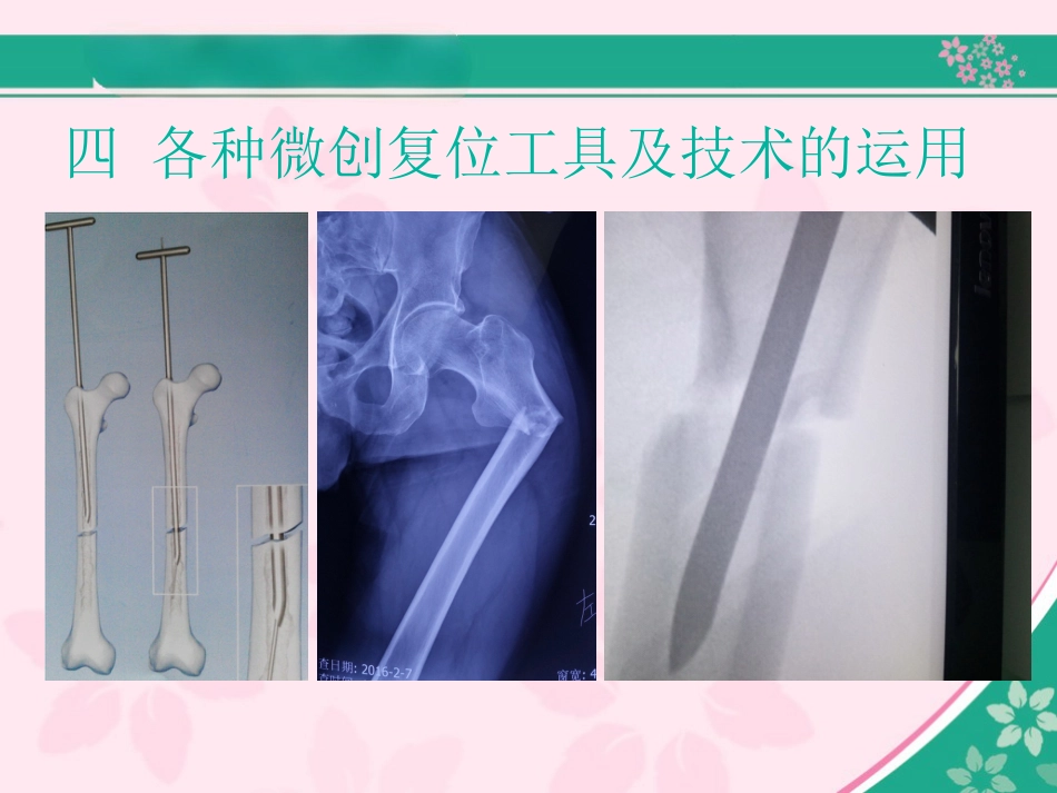 外科学：股骨近端骨折的几个感悟_第11页