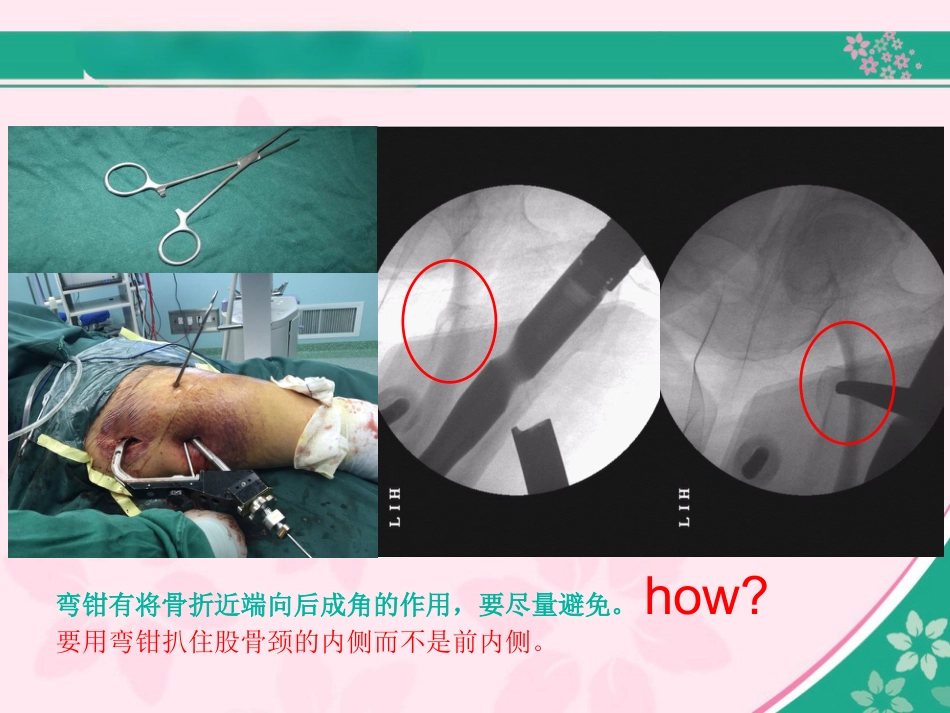 外科学：股骨近端骨折的几个感悟_第12页