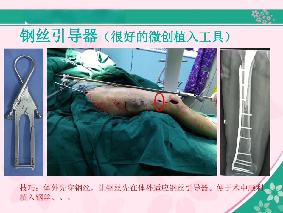 外科学：股骨近端骨折的几个感悟_第14页