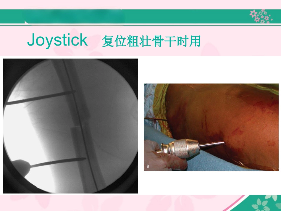 外科学：股骨近端骨折的几个感悟_第15页
