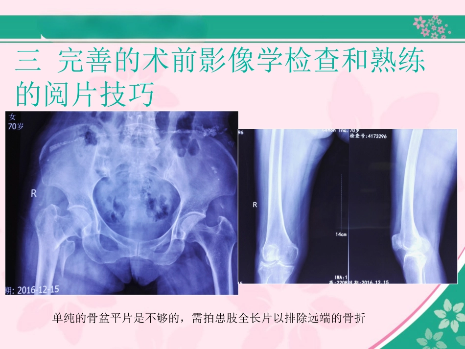 外科学：股骨近端骨折的几个感悟_第6页