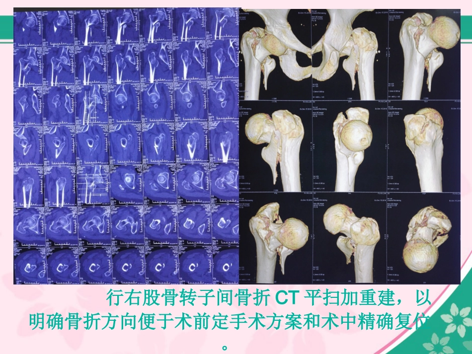 外科学：股骨近端骨折的几个感悟_第7页