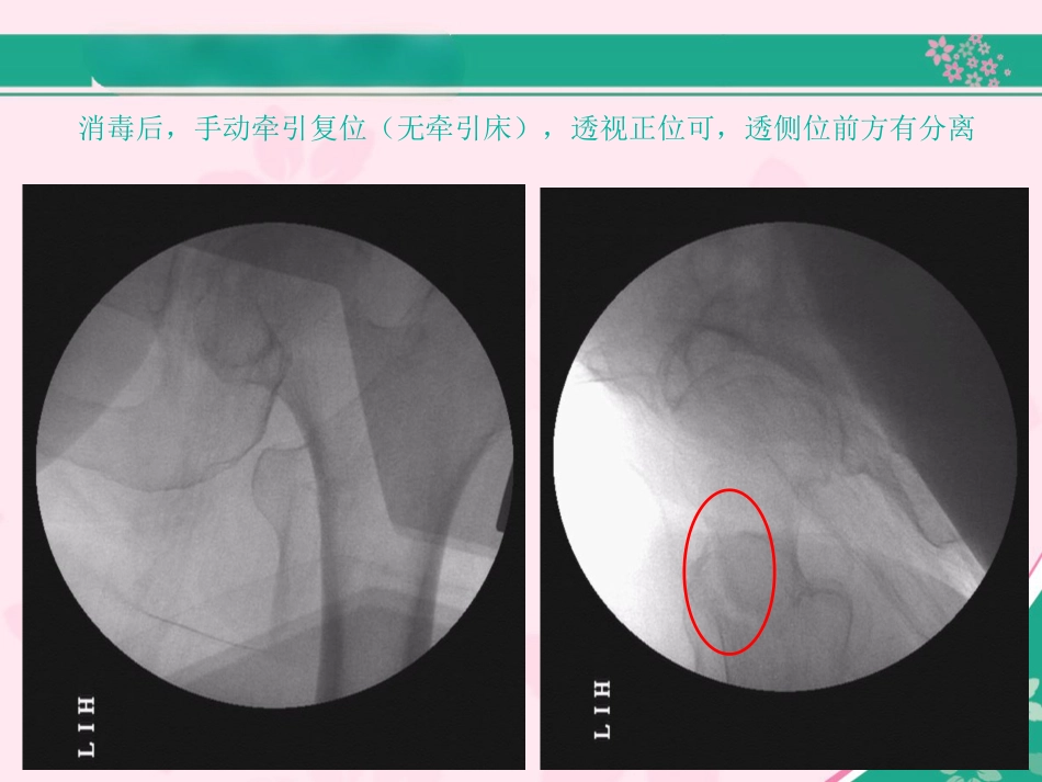 外科学：股骨近端骨折的几个感悟_第8页