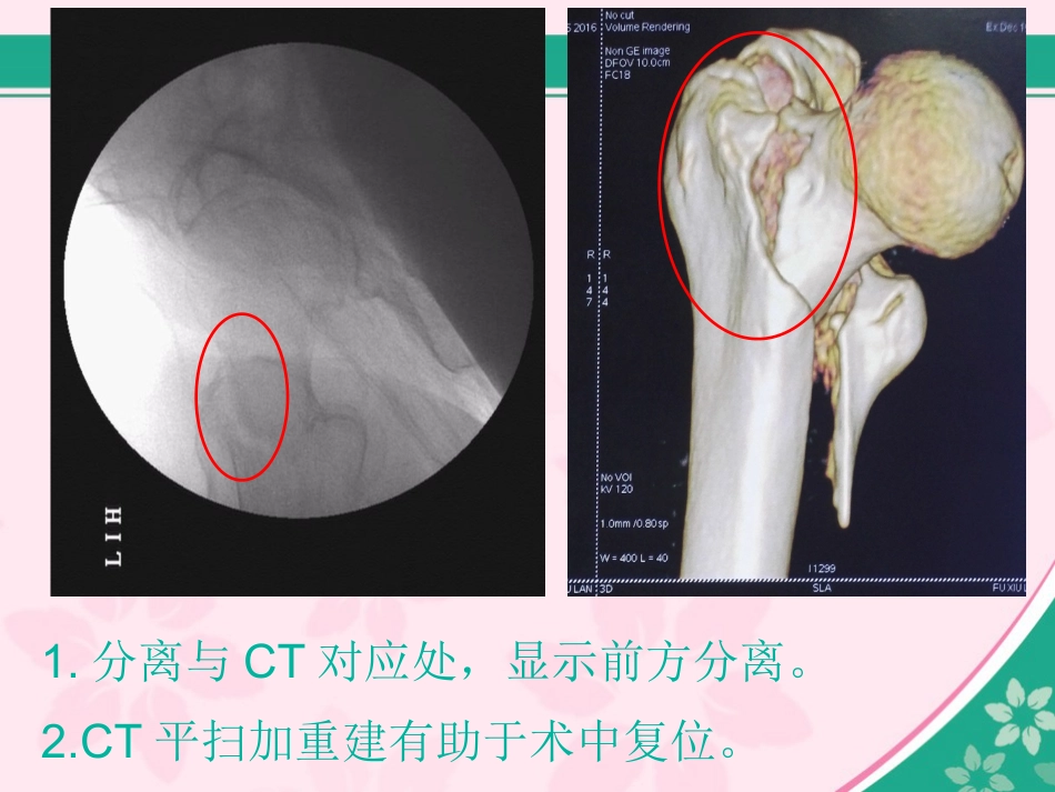 外科学：股骨近端骨折的几个感悟_第9页