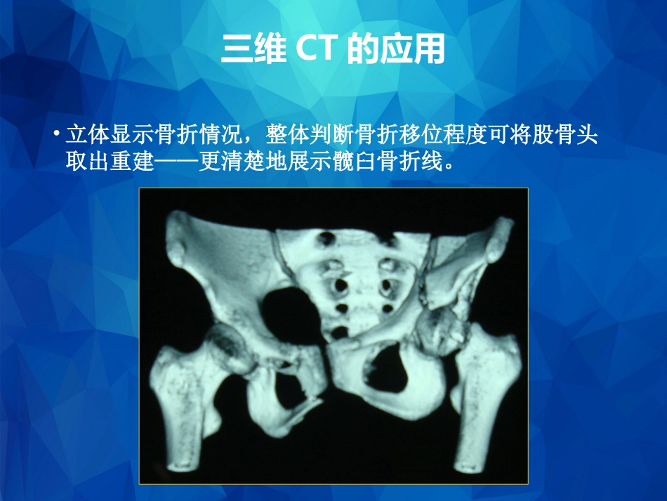 外科学：Stoppa及其改良入路的简介及临床应用_第15页