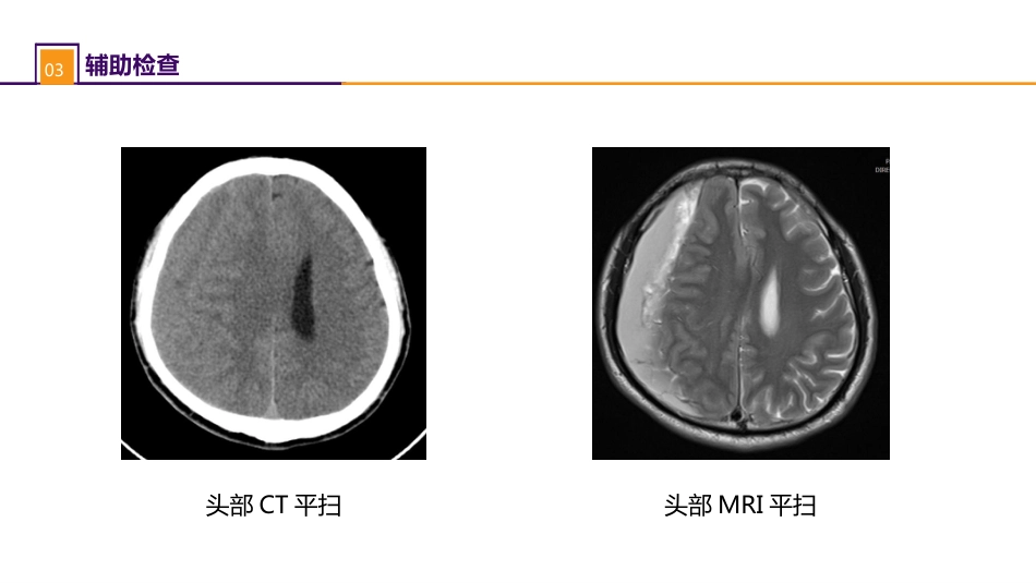 外科学：颅脑损伤案例分析-慢性硬膜下血肿_第6页