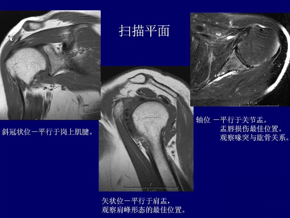 外科学：肩关节MR_第12页