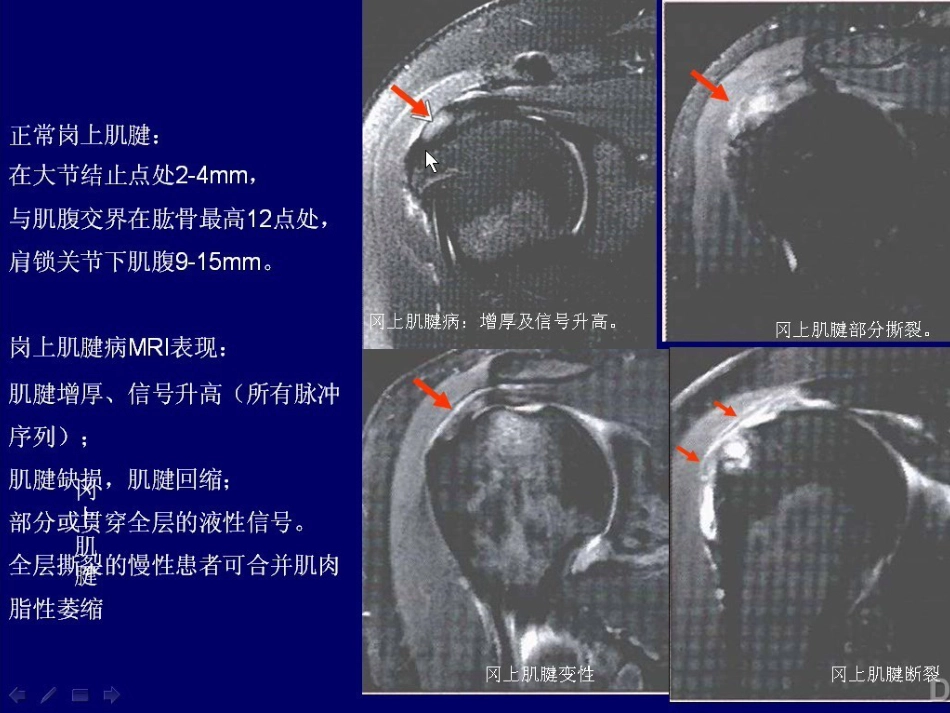外科学：肩关节MR_第14页