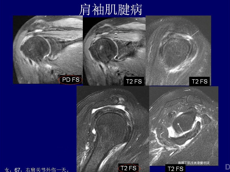 外科学：肩关节MR_第15页