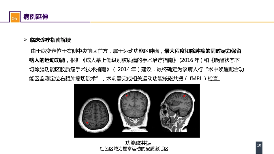 外科学：案例分析-大脑胶质瘤_第10页